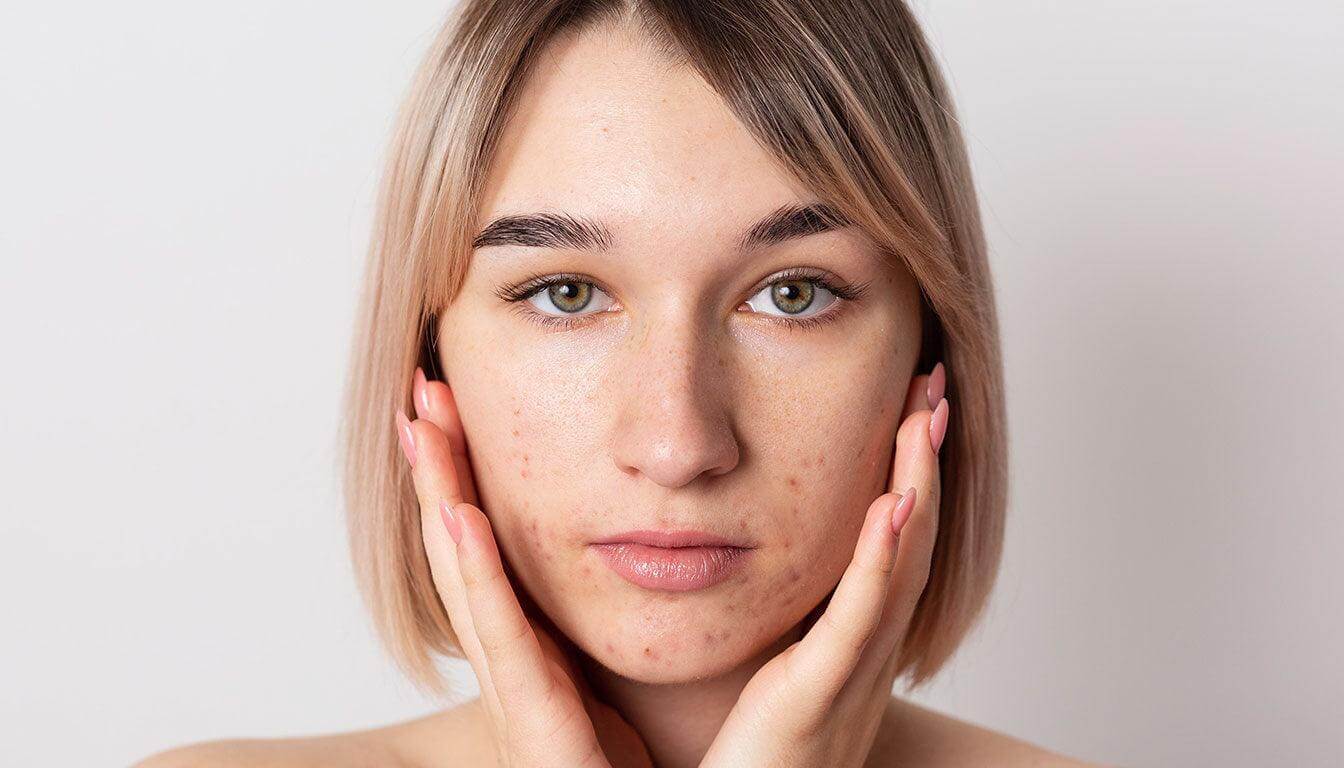 Lekeli Ciltler İçin En İyi Serum Önerileri - LAPÉRAS