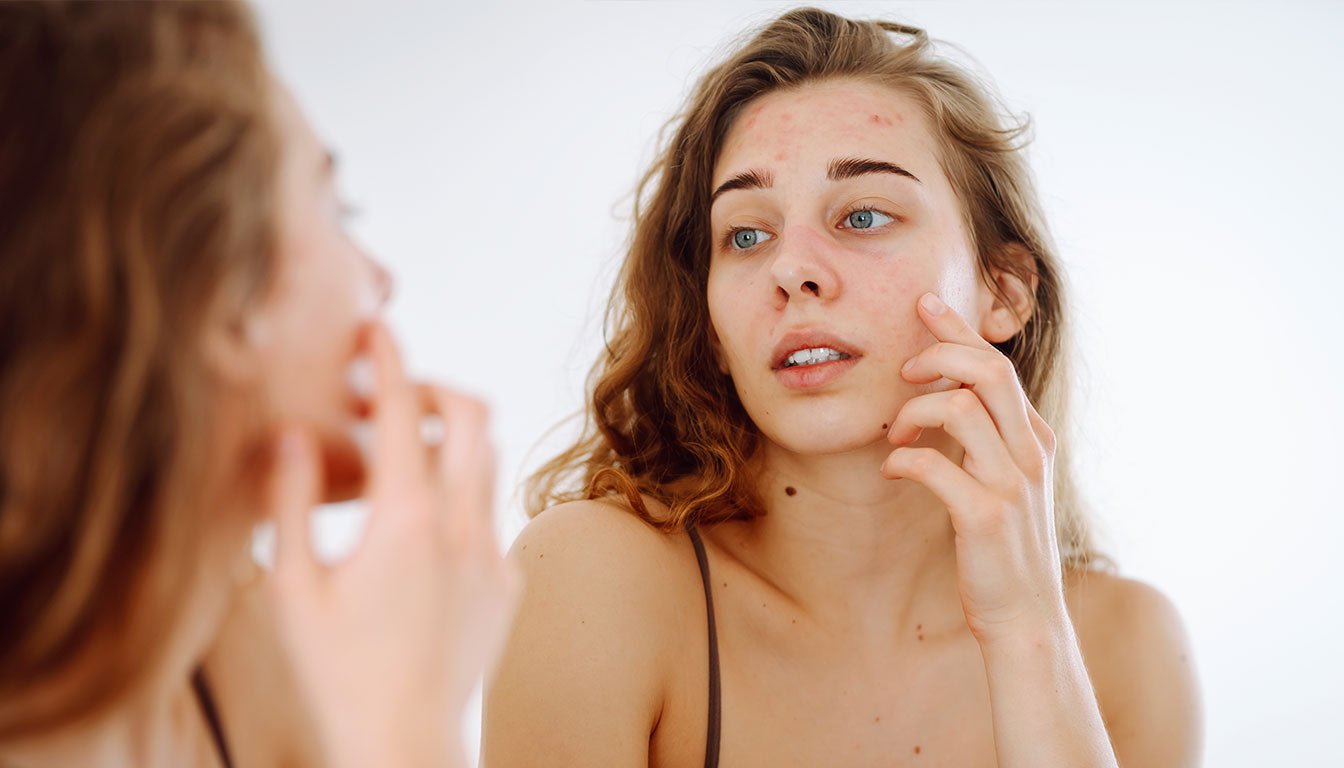 Kör Sivilce Nedir? Neden Oluşur ve Nasıl Geçer? - LAPÉRAS